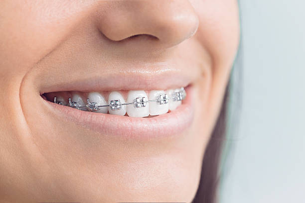 Dental Bonding in Tanglewilde, WA